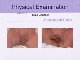 Physical Examination Normal  Undescended Testes Male Genitalia 