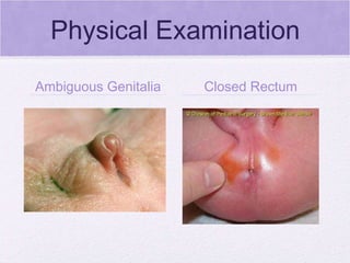 Physical Examination Ambiguous Genitalia Closed Rectum 