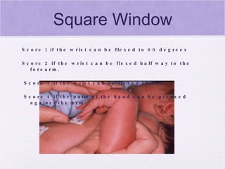 Square Window Score 1 if the wrist can be flexed to 60 degrees Score 2 if the wrist can be flexed half way to the forearm.  Score 3 if the wrist can be flexed to 30.  Score 4 if the palm of the hand can be pressed against the arm 
