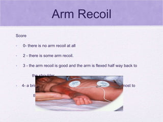 Arm Recoil Score 0- there is no arm recoil at all 2 - there is some arm recoil.  3 - the arm recoil is good and the arm is flexed half way back to   the shoulder 4- a brisk arm recoil and the infant pulls the arm back almost to   the shoulder.   