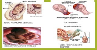ROTURA PREMATURA DE MEMBRANAS PLACENTA PREVIA
CRECIMIENTO INTRAUTERINOTETARDADO
USO DE FORCEPS EN EL PARTO ,
DESGARROS
 