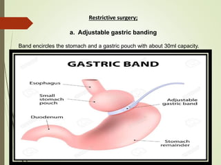 Restrictive surgery;
a. Adjustable gastric banding
Band encircles the stomach and a gastric pouch with about 30ml capacity.
 