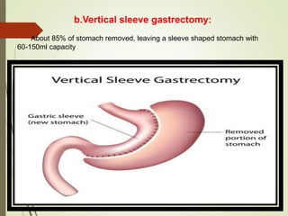 b.Vertical sleeve gastrectomy:
About 85% of stomach removed, leaving a sleeve shaped stomach with
60-150ml capacity
 