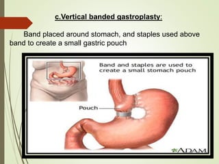 c.Vertical banded gastroplasty:
Band placed around stomach, and staples used above
band to create a small gastric pouch
 
