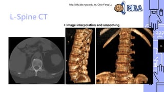 http://cflu.lab.nycu.edu.tw, Chia-Feng Lu
25
L-Spine CT
+ Image interpolation and smoothing
 