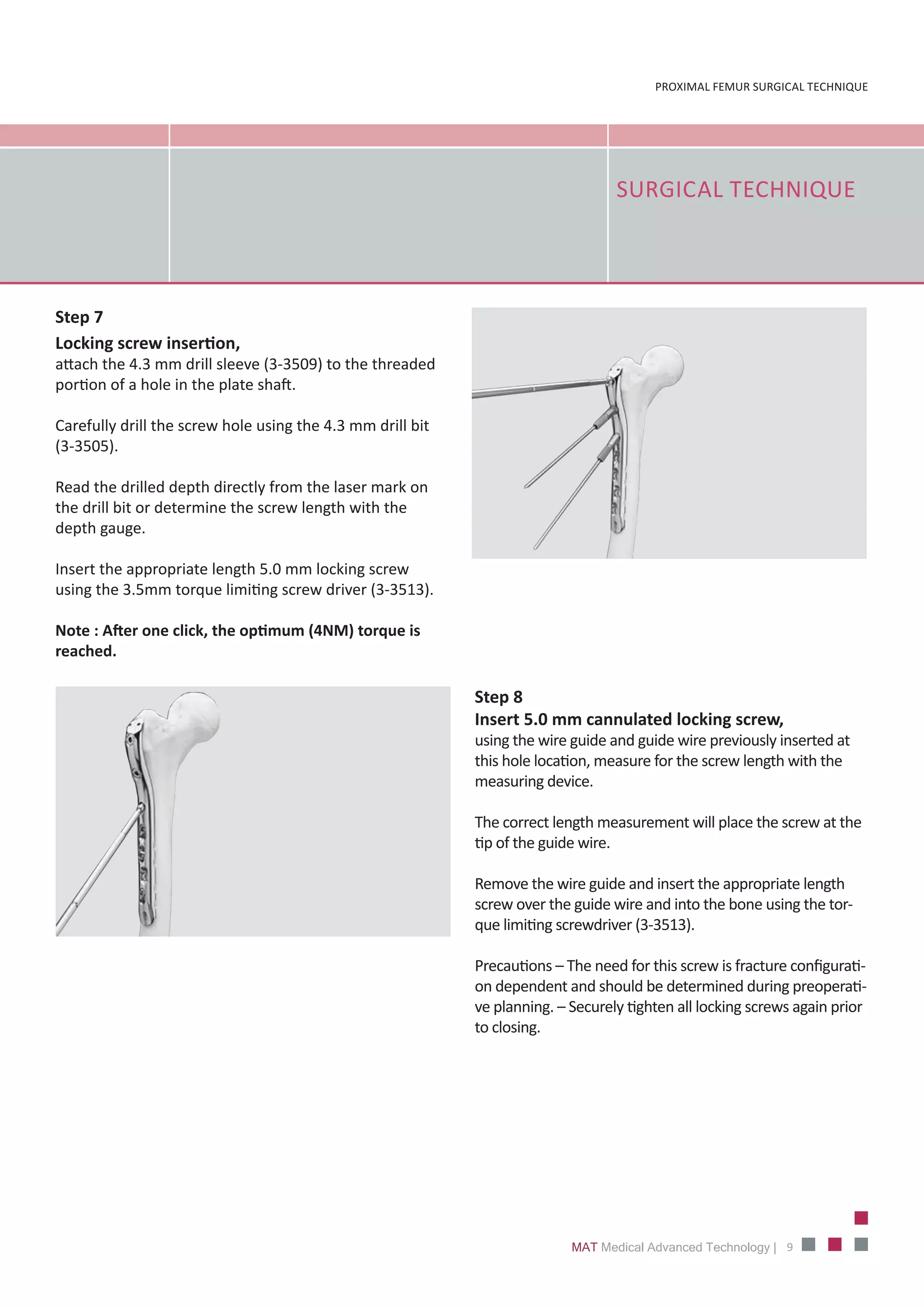 MAT - Proximal Femur Plate | PDF