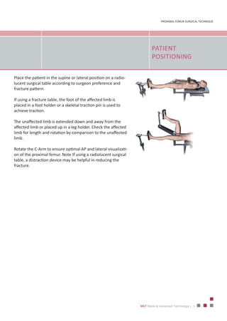5
PROXIMAL FEMUR SURGICAL TECHNIQUE
MAT Medical Advanced Technology |
PATIENT
POSITIONING
Place the patient in the supine or lateral position on a radio‐
lucent surgical table according to surgeon preference and
fracture pattern.
If using a fracture table, the foot of the affected limb is
placed in a foot holder or a skeletal traction pin is used to
achieve traction.
The unaffected limb is extended down and away from the
affected limb or placed up in a leg holder. Check the affected
limb for length and rotation by comparison to the unaffected
limb.
Rotate the C‐Arm to ensure optimal AP and lateral visualizati‐
on of the proximal femur. Note If using a radiolucent surgical
table, a distraction device may be helpful in reducing the
fracture.
 