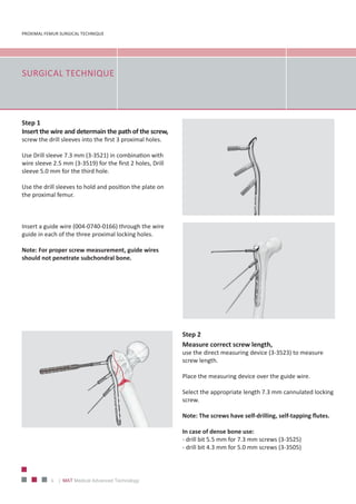 PROXIMAL FEMUR SURGICAL TECHNIQUE
6 | MAT Medical Advanced Technology
SURGICAL TECHNIQUE
Step 1
Insert the wire and determain the path of the screw,
screw the drill sleeves into the first 3 proximal holes.
Use Drill sleeve 7.3 mm (3‐3521) in combination with
wire sleeve 2.5 mm (3‐3519) for the first 2 holes, Drill
sleeve 5.0 mm for the third hole.
Use the drill sleeves to hold and position the plate on
the proximal femur.
Insert a guide wire (004‐0740‐0166) through the wire
guide in each of the three proximal locking holes.
Note: For proper screw measurement, guide wires
should not penetrate subchondral bone.
Step 2
Measure correct screw length,
use the direct measuring device (3‐3523) to measure
screw length.
Place the measuring device over the guide wire.
Select the appropriate length 7.3 mm cannulated locking
screw.
Note: The screws have self‐drilling, self‐tapping flutes.
In case of dense bone use:
‐ drill bit 5.5 mm for 7.3 mm screws (3‐3525)
‐ drill bit 4.3 mm for 5.0 mm screws (3‐3505)
 