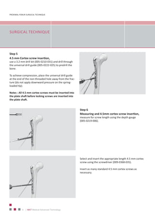 PROXIMAL FEMUR SURGICAL TECHNIQUE
8 | MAT Medical Advanced Technology
SURGICAL TECHNIQUE
Step 6
Measuring and 4.5mm cortex screw insertion,
measure for screw length using the depth gauge
(005‐0219‐006).
Select and insert the appropriate length 4.5 mm cortex
screw using the screwdriver (009‐0368‐035).
Insert as many standard 4.5 mm cortex screws as
necessary.
Step 5
4.5 mm Cortex screw insertion,
use a 3.2 mm drill bit (005‐0210‐031) and drill through
the universal drill guide (005‐0222‐025) to predrill the
bone.
To achieve compression, place the universal drill guide
at the end of the non‐threaded hole away from the frac‐
ture (do not apply downward pressure on the spring‐
loaded tip).
Notes : All 4.5 mm cortex screws must be inserted into
the plate shaft before locking screws are inserted into
the plate shaft.
 