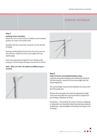 9
PROXIMAL FEMUR SURGICAL TECHNIQUE
MAT Medical Advanced Technology |
SURGICAL TECHNIQUE
Step 8
Insert 5.0 mm cannulated locking screw,
using the wire guide and guide wire previously inserted at
this hole location, measure for the screw length with the
measuring device.
The correct length measurement will place the screw at the
tip of the guide wire.
Remove the wire guide and insert the appropriate length
screw over the guide wire and into the bone using the tor‐
que limiting screwdriver (3‐3513).
Precautions – The need for this screw is fracture configurati‐
on dependent and should be determined during preoperati‐
ve planning. – Securely tighten all locking screws again prior
to closing.
Step 7
Locking screw insertion,
attach the 4.3 mm drill sleeve (3‐3509) to the threaded
portion of a hole in the plate shaft.
Carefully drill the screw hole using the 4.3 mm drill bit
(3‐3505).
Read the drilled depth directly from the laser mark on
the drill bit or determine the screw length with the
depth gauge.
Insert the appropriate length 5.0 mm locking screw
using the 3.5mm torque limiting screw driver (3‐3513).
Note : After one click, the optimum (4NM) torque is
reached.
 