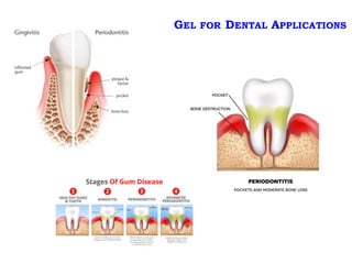 GEL FOR DENTAL APPLICATIONS
 