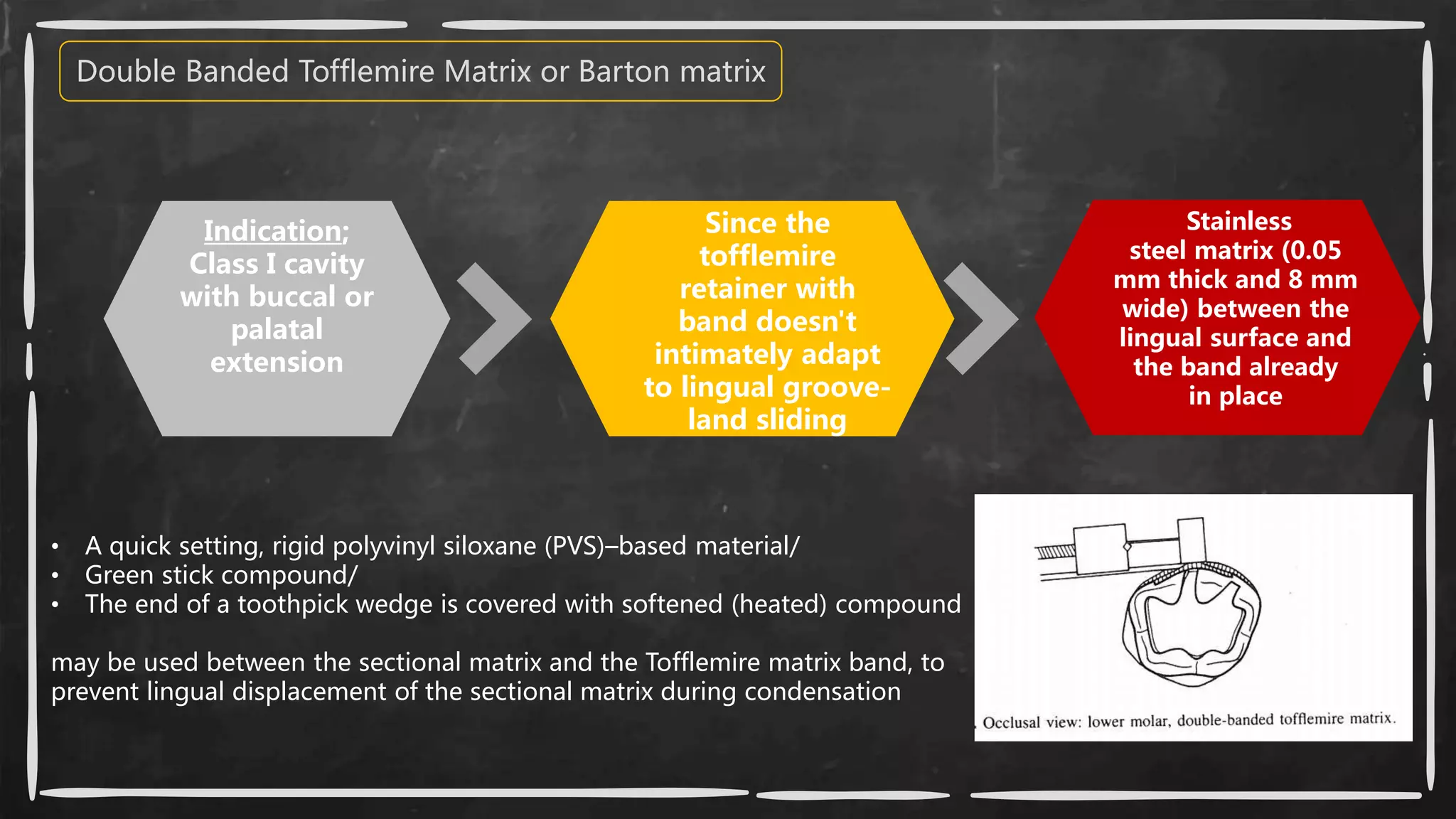 Indication;
Class I cavity
with buccal or
palatal
extension
Since the
tofflemire
retainer with
band doesn't
intimately adapt
to lingual groove-
land sliding
Stainless
steel matrix (0.05
mm thick and 8 mm
wide) between the
lingual surface and
the band already
in place
• A quick setting, rigid polyvinyl siloxane (PVS)–based material/
• Green stick compound/
• The end of a toothpick wedge is covered with softened (heated) compound
may be used between the sectional matrix and the Tofflemire matrix band, to
prevent lingual displacement of the sectional matrix during condensation
Double Banded Tofflemire Matrix or Barton matrix
 