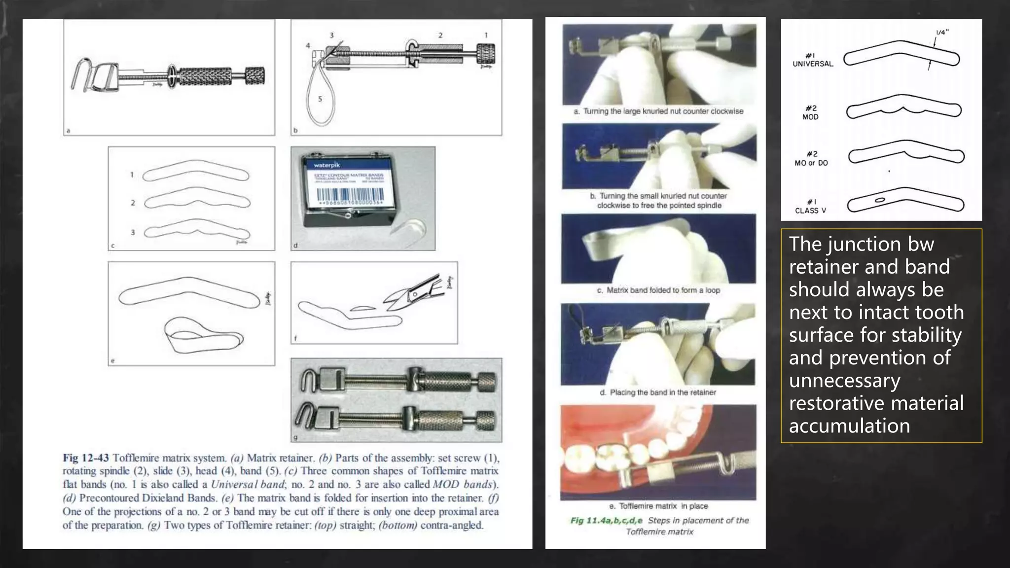 •
The junction bw
retainer and band
should always be
next to intact tooth
surface for stability
and prevention of
unnecessary
restorative material
accumulation
 