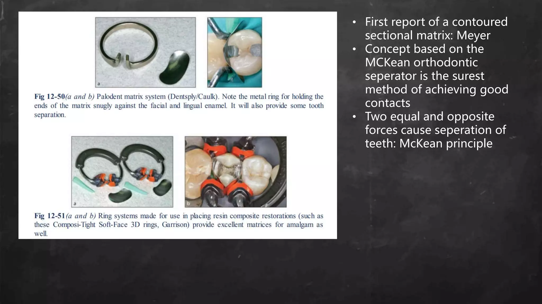 • First report of a contoured
sectional matrix: Meyer
• Concept based on the
MCKean orthodontic
seperator is the surest
method of achieving good
contacts
• Two equal and opposite
forces cause seperation of
teeth: McKean principle
 
