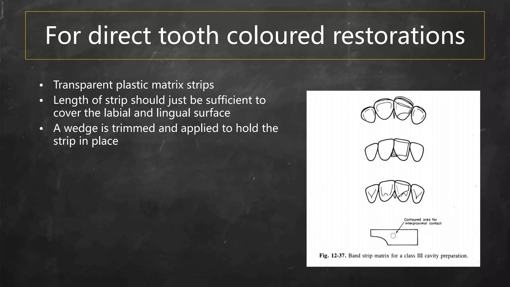 For direct tooth coloured restorations
• Transparent plastic matrix strips
• Length of strip should just be sufficient to
cover the labial and lingual surface
• A wedge is trimmed and applied to hold the
strip in place
 