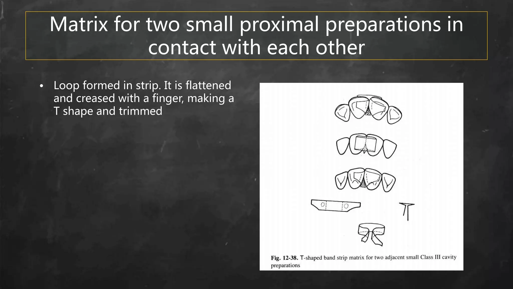 Matrix for two small proximal preparations in
contact with each other
• Loop formed in strip. It is flattened
and creased with a finger, making a
T shape and trimmed
 