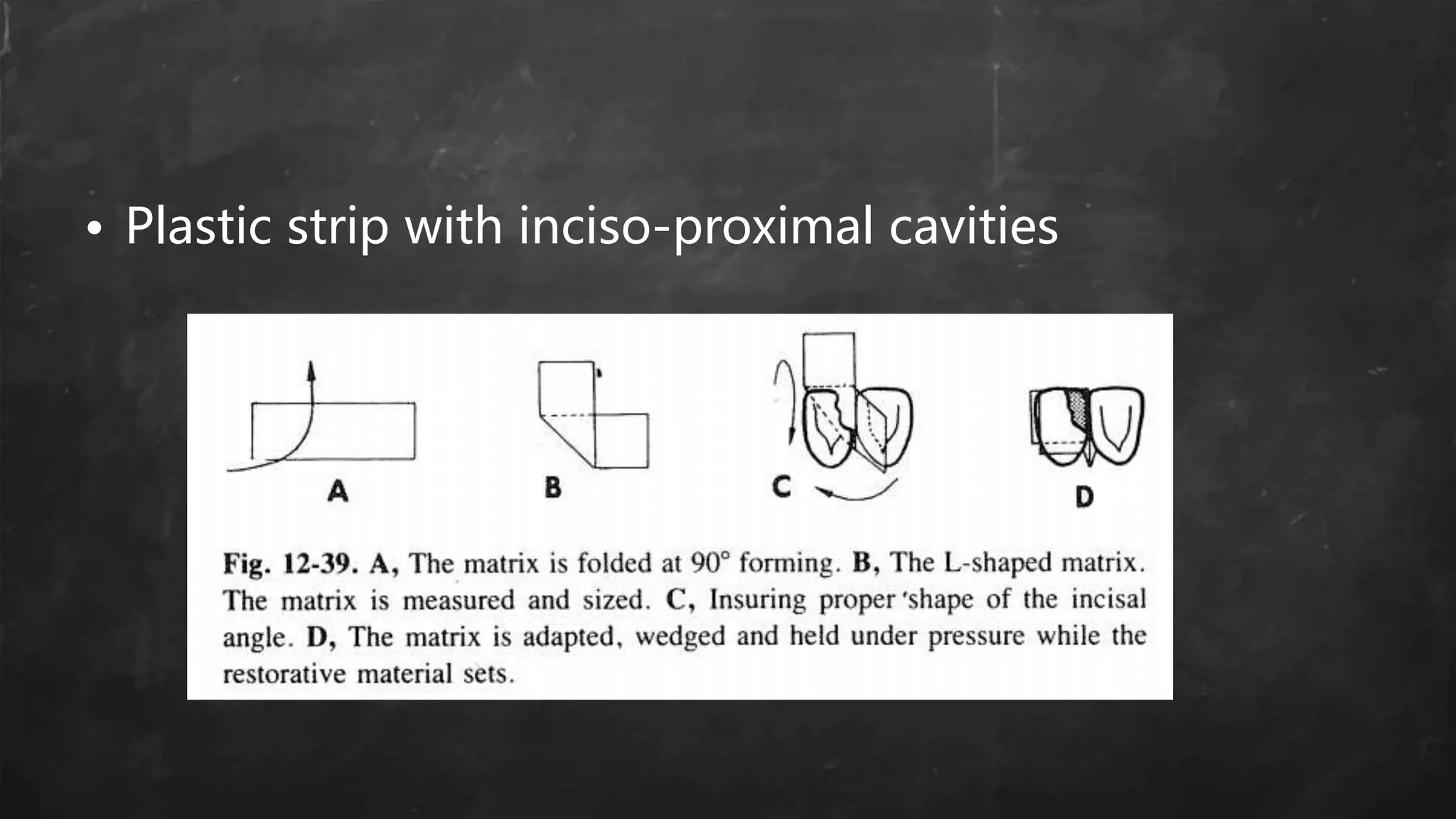 • Plastic strip with inciso-proximal cavities
 
