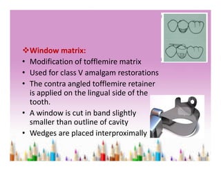 Matrices, retainers and wedges | PDF