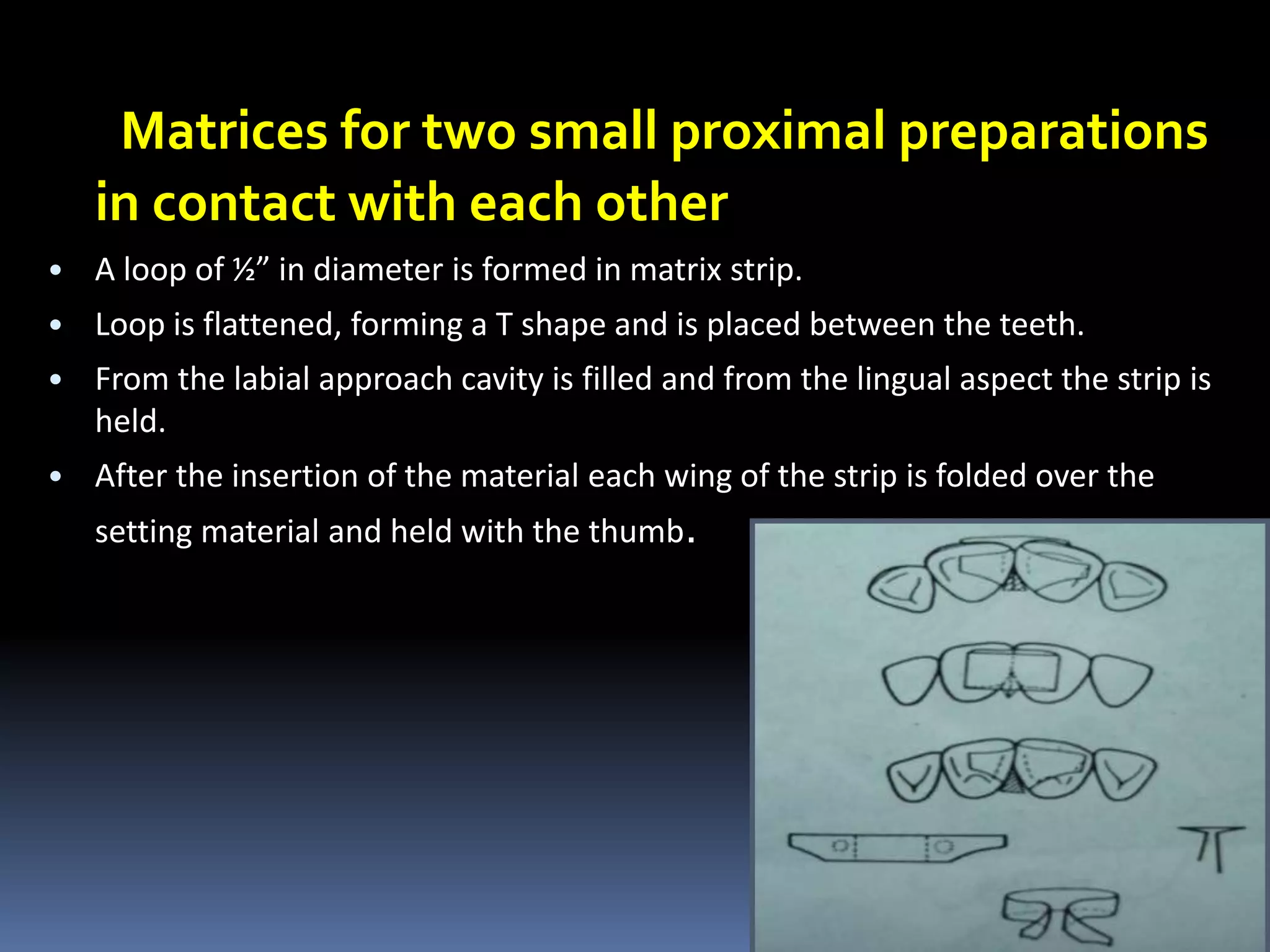 Matrices for two small proximal preparations
in contact with each other
• A loop of ½” in diameter is formed in matrix strip.
• Loop is flattened, forming a T shape and is placed between the teeth.
• From the labial approach cavity is filled and from the lingual aspect the strip is
held.
• After the insertion of the material each wing of the strip is folded over the
setting material and held with the thumb.
23
 