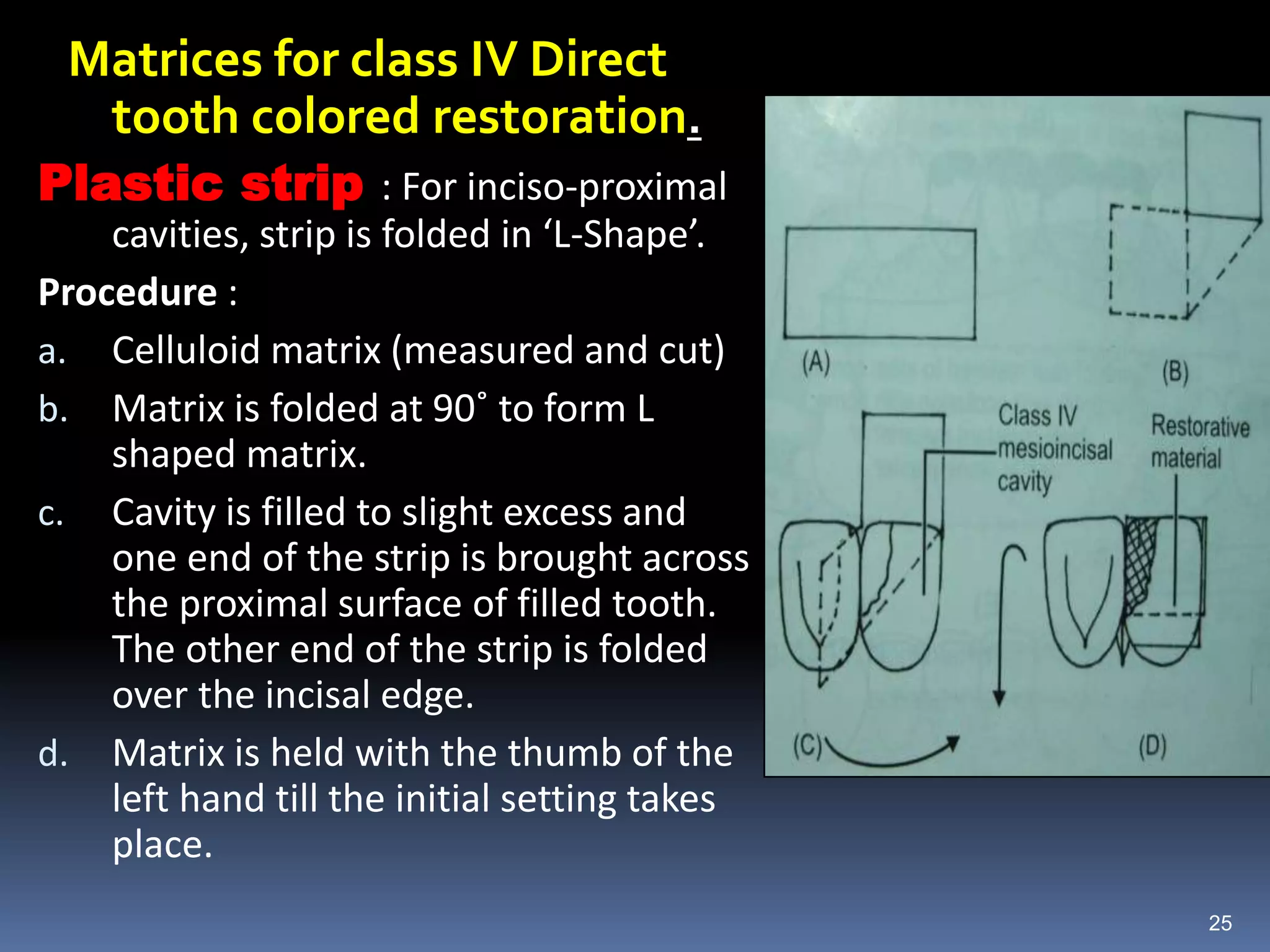 Matrices for class IV Direct
tooth colored restoration.
Plastic strip : For inciso-proximal
cavities, strip is folded in ‘L-Shape’.
Procedure :
a. Celluloid matrix (measured and cut)
b. Matrix is folded at 90˚ to form L
shaped matrix.
c. Cavity is filled to slight excess and
one end of the strip is brought across
the proximal surface of filled tooth.
The other end of the strip is folded
over the incisal edge.
d. Matrix is held with the thumb of the
left hand till the initial setting takes
place.
25
 
