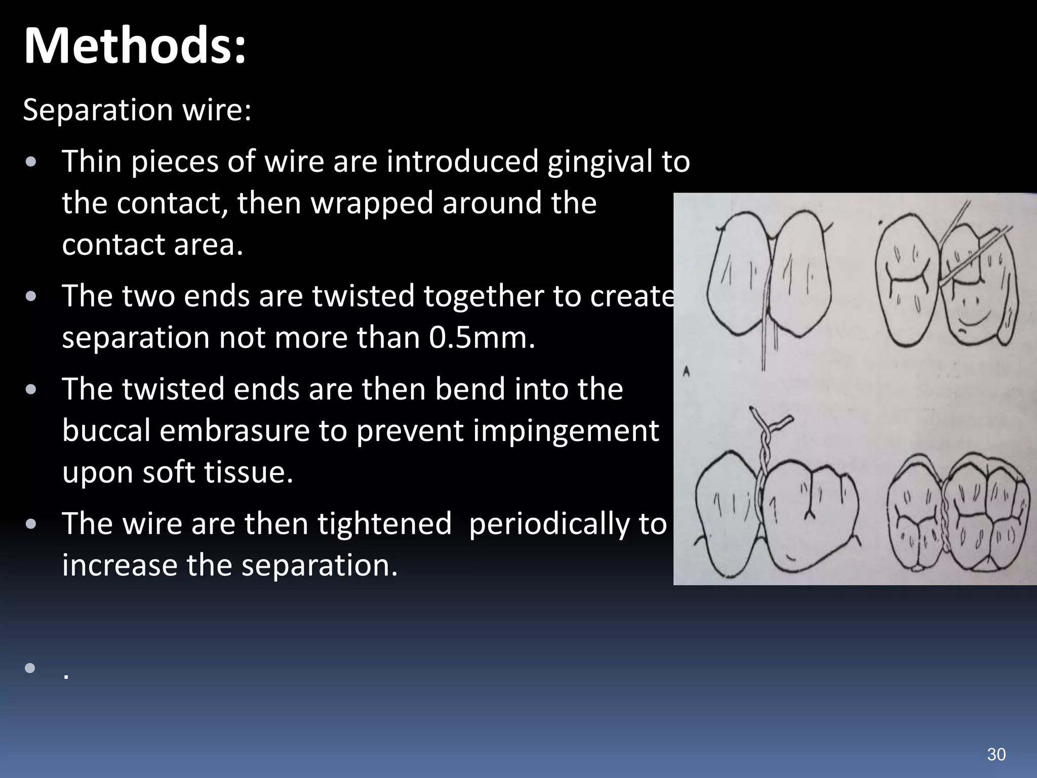 Methods:
Separation wire:
• Thin pieces of wire are introduced gingival to
the contact, then wrapped around the
contact area.
• The two ends are twisted together to create
separation not more than 0.5mm.
• The twisted ends are then bend into the
buccal embrasure to prevent impingement
upon soft tissue.
• The wire are then tightened periodically to
increase the separation.
• .
30
 