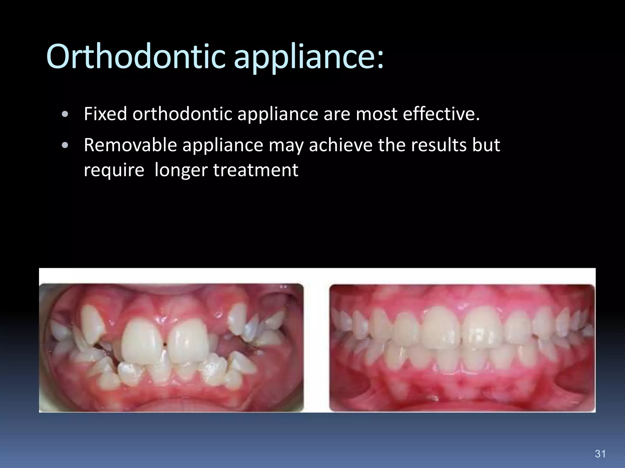 Orthodontic appliance:
• Fixed orthodontic appliance are most effective.
• Removable appliance may achieve the results but
require longer treatment
31
 