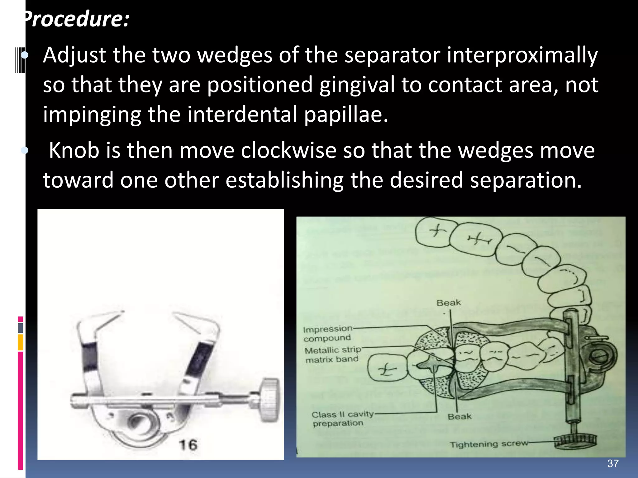 Procedure:
• Adjust the two wedges of the separator interproximally
so that they are positioned gingival to contact area, not
impinging the interdental papillae.
• Knob is then move clockwise so that the wedges move
toward one other establishing the desired separation.
37
 