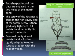 • Two sharp points of the
claw are engaged in the
two holes of the matrix
band.
• The screw of the retainer is
kept on the non-cavity side
of the tooth, screw is then
gradually tightened till
matrix band perfectly fits
around the tooth.
• Proximal cavity side of
matrix band is further
tightly adapted to outer
surface of tooth with the
help of wedge.
10
Ivory no.1 Retainer and Matrix
band
(A) Premolar (B) Molars
 