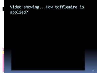 Video showing...How tofflemire is
applied?
17
 