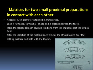 Matrices for two small proximal preparations
in contact with each other
• A loop of ½” in diameter is formed in matrix strip.
• Loop is flattened, forming a T shape and is placed between the teeth.
• From the labial approach cavity is filled and from the lingual aspect the strip is
held.
• After the insertion of the material each wing of the strip is folded over the
setting material and held with the thumb.
23
 