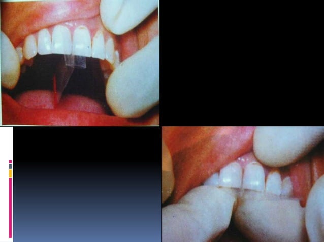 Matrices, retainers, wedges and separators | PPT | Dental Health ...
