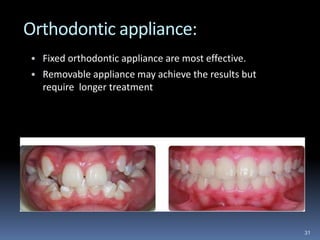 Orthodontic appliance:
• Fixed orthodontic appliance are most effective.
• Removable appliance may achieve the results but
require longer treatment
31
 
