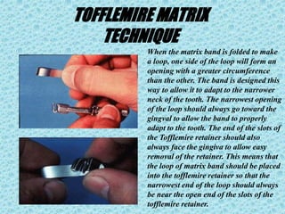 TOFFLEMIRE MATRIX
TECHNIQUE
When the matrix band is folded to make
a loop, one side of the loop will form an
opening with a greater circumference
than the other. The band is designed this
way to allow it to adapt to the narrower
neck of the tooth. The narrowest opening
of the loop should always go toward the
gingval to allow the band to properly
adapt to the tooth. The end of the slots of
the Tofflemire retainer should also
always face the gingiva to allow easy
removal of the retainer. This means that
the loop of matrix band should be placed
into the tofflemire retainer so that the
narrowest end of the loop should always
be near the open end of the slots of the
tofflemire retainer.
 