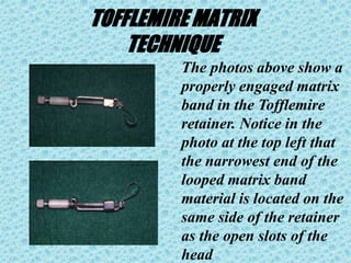 TOFFLEMIRE MATRIX
TECHNIQUE
The photos above show a
properly engaged matrix
band in the Tofflemire
retainer. Notice in the
photo at the top left that
the narrowest end of the
looped matrix band
material is located on the
same side of the retainer
as the open slots of the
head
 