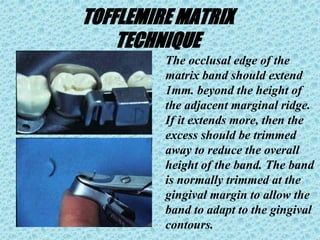 TOFFLEMIRE MATRIX
TECHNIQUE
The occlusal edge of the
matrix band should extend
1mm. beyond the height of
the adjacent marginal ridge.
If it extends more, then the
excess should be trimmed
away to reduce the overall
height of the band. The band
is normally trimmed at the
gingival margin to allow the
band to adapt to the gingival
contours.
 