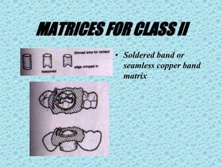 MATRICES FOR CLASS II
• Soldered band or
seamless copper band
matrix
 