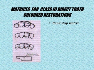MATRICES FOR CLASS III DIRECT TOOTH
COLOURED RESTORATIONS
• Band strip matrix
 