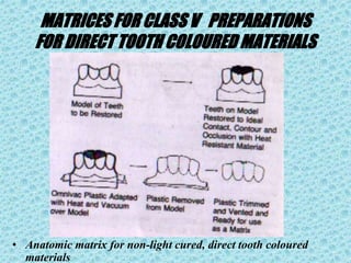 MATRICES FOR CLASS V PREPARATIONS
FOR DIRECT TOOTH COLOURED MATERIALS
• Anatomic matrix for non-light cured, direct tooth coloured
materials
 