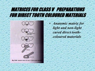 MATRICES FOR CLASS V PREPARATIONS
FOR DIRECT TOOTH COLOURED MATERIALS
• Anatomic matrix for
light and non-light
cured direct tooth-
coloured materials
 