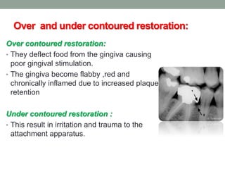 Over and under contoured restoration:
Over contoured restoration:
• They deflect food from the gingiva causing
poor gingival stimulation.
• The gingiva become flabby ,red and
chronically inflamed due to increased plaque
retention
Under contoured restoration :
• This result in irritation and trauma to the
attachment apparatus.
 