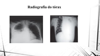 Radiografia do tóraxRadiografia do tórax
 