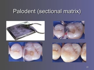 2929
Palodent (sectional matrix)Palodent (sectional matrix)
 