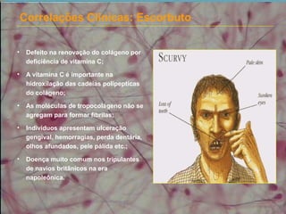 Correlações Clínicas: Escorbuto
• Defeito na renovação do colágeno por
deficiência de vitamina C;
• A vitamina C é importante na
hidroxilação das cadeias polipeptícas
do colágeno;
• As moléculas de tropocolágeno não se
agregam para formar fibrilas;
• Indivíduos apresentam ulceração
gengival, hemorragias, perda dentária,
olhos afundados, pele pálida etc.;
• Doença muito comum nos tripulantes
de navios britânicos na era
napoleônica.
 