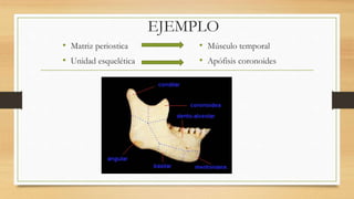 EJEMPLO
• Matriz periostica
• Unidad esquelética
• Músculo temporal
• Apófisis coronoides
 