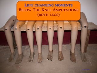 https://flic.kr/p/hhF9XR
LIIFE CHANGING MOMENTS
BELOW THE KNEE AMPUTATIONS
(BOTH LEGS)
 