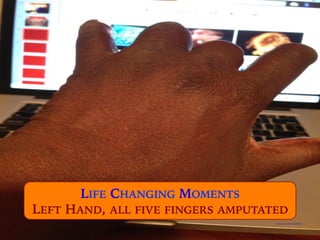 Photo by Calvin Matthews
LIFE CHANGING MOMENTS
LEFT HAND, ALL FIVE FINGERS AMPUTATED
 
