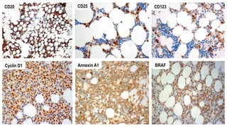 CD20 CD25 CD123
Cyclin D1 Annexin A1 BRAF
 