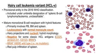 Hairy cell leukemia variant (HCL-v)
• Provisional entity in the 2016 WHO classification.
oIncluded under umbrella designation of “splenic B-cell
lymphoma/leukemia, unclassifiable”.
• Mature monoclonal B-cell neoplasm with hybrid features
oPrimarily involves PB, BM and spleen.
oLeukocytosis with normal monocyte count.
oHairy projections and nucleoli; hybrid morphology.
oNegative for some classic HCL antigens (CD25,
annexin-A1, CD123, BRAF).
oBRAF V600E wild type (i.e. no mutation).
oRed pulp infiltration of spleen.
 