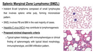 Splenic Marginal Zone Lymphoma (SMZL)
• Indolent B-cell lymphoma composed of small lymphocytes
that involves splenic white pulp, forming micronodular
pattern.
• SMZL involves PB and BM in the vast majority of cases.
• Hepatitis C virus (HCV) may contribute to lymphomagenesis
• Proposed minimal diagnostic criteria
oTypical spleen histology with immunophenotype or clinical
finding of splenomegaly with typical blood morphology,
immunophenotype, and BM infiltration pattern.
 