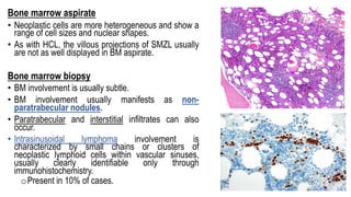 Bone marrow aspirate
• Neoplastic cells are more heterogeneous and show a
range of cell sizes and nuclear shapes.
• As with HCL, the villous projections of SMZL usually
are not as well displayed in BM aspirate.
Bone marrow biopsy
• BM involvement is usually subtle.
• BM involvement usually manifests as non-
paratrabecular nodules.
• Paratrabecular and interstitial infiltrates can also
occur.
• Intrasinusoidal lymphoma involvement is
characterized by small chains or clusters of
neoplastic lymphoid cells within vascular sinuses,
usually clearly identifiable only through
immunohistochemistry.
oPresent in 10% of cases.
 
